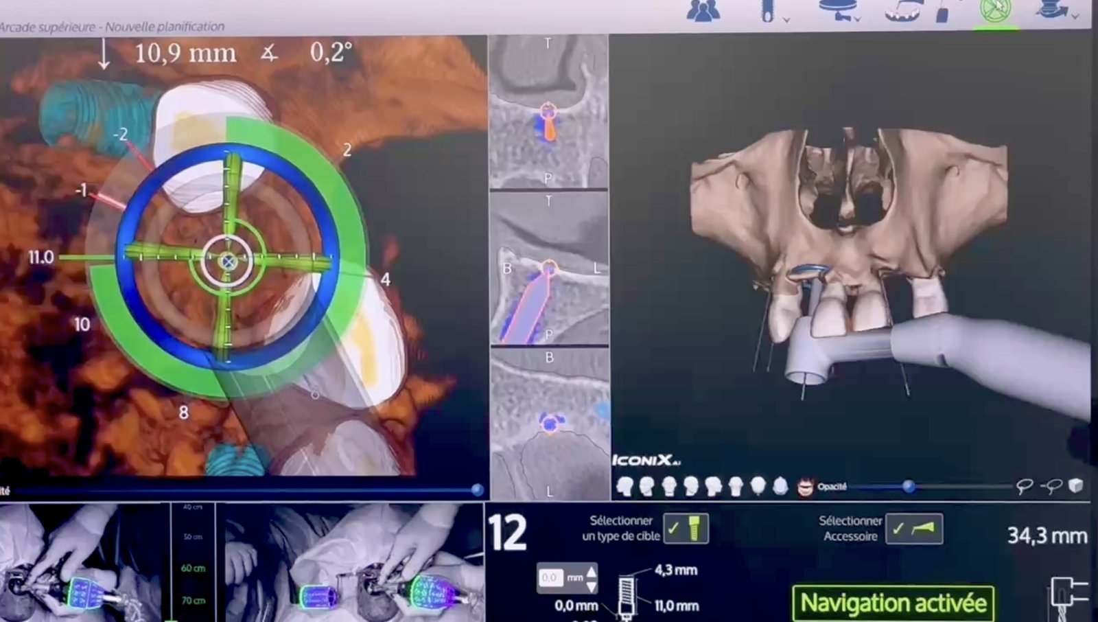 Navigation chirurgicale en temps réel pour la pose d'implants dentaires — planification affichée à l'écran
