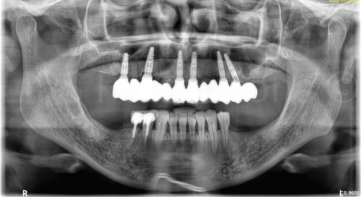 Radiographie panoramique d'une réhabilitation complète sur six implants dentaires — All-on-6