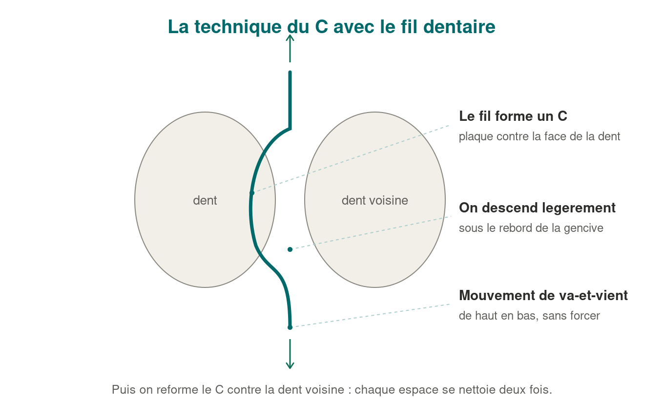 Schéma de la technique du C avec le fil dentaire : le fil épouse la face de la dent et descend légèrement sous la gencive