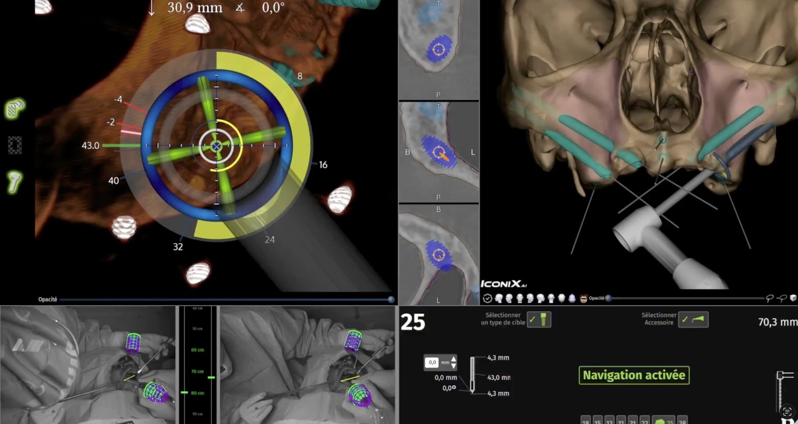 Trajet d'un implant zygomatique planifié sur imagerie 3D, du maxillaire à l'os de la pommette