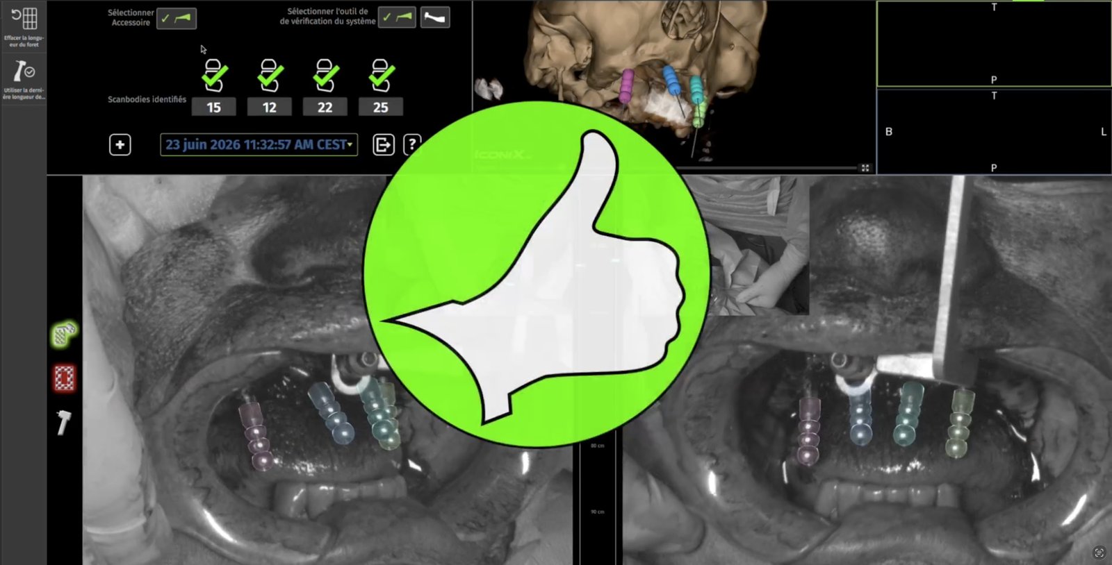 Vue de la planification des implants zygomatiques et conventionnels pour une réhabilitation complète du maxillaire