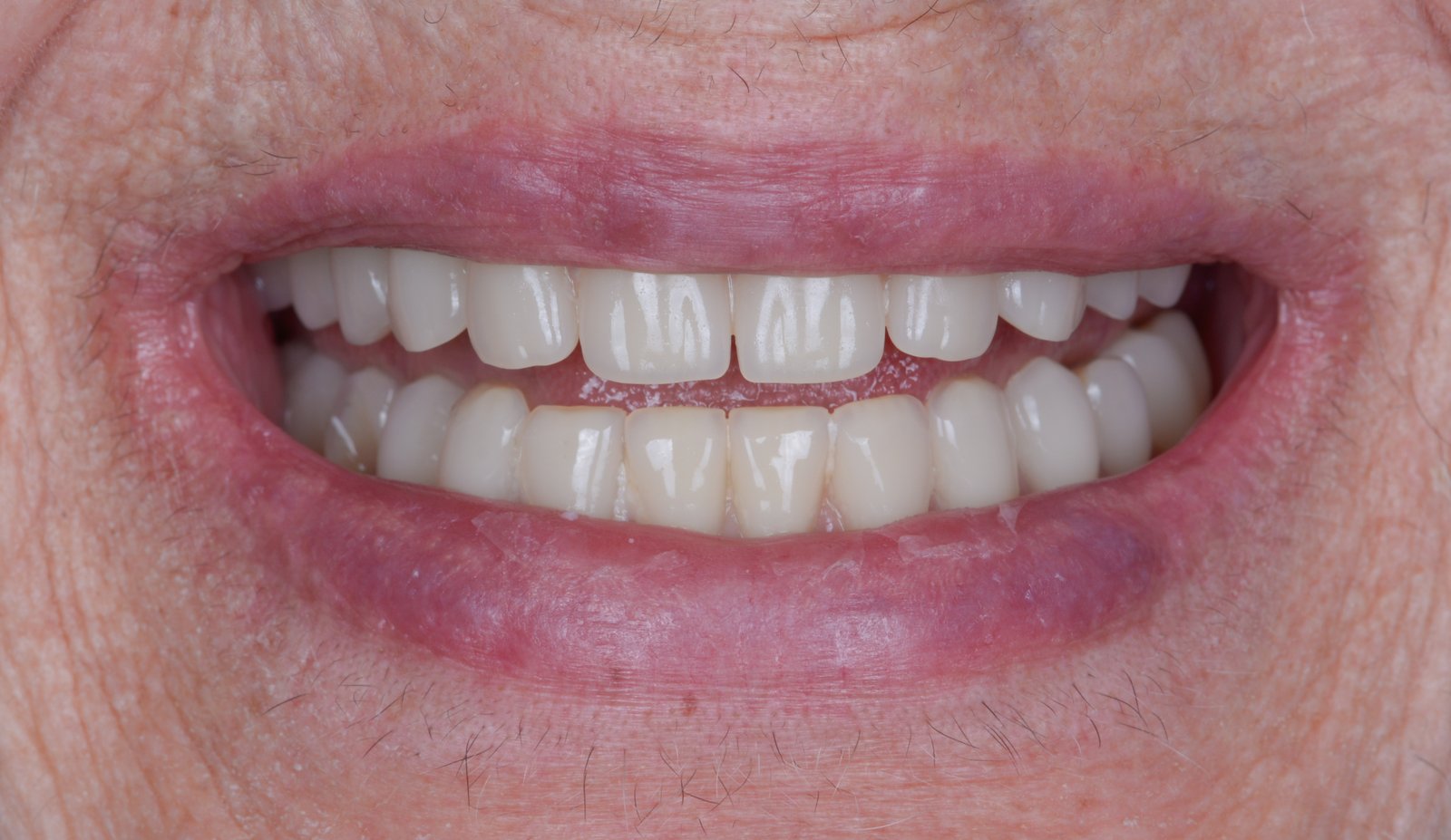 Sourire final après réhabilitation complète sur implants zygomatiques — Dr Choquet, Aix-en-Provence